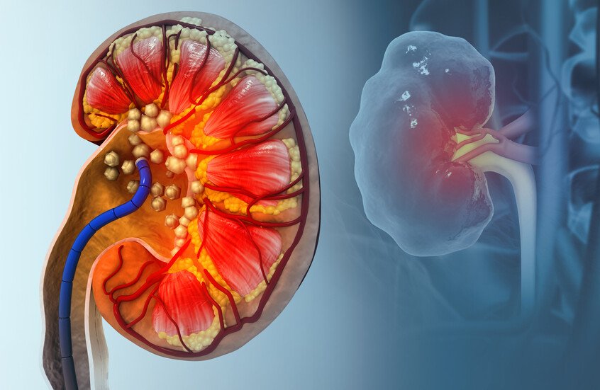 دراسة تفجر مفاجأة عن السبب الحقيقي لتكون حصوات الكلى