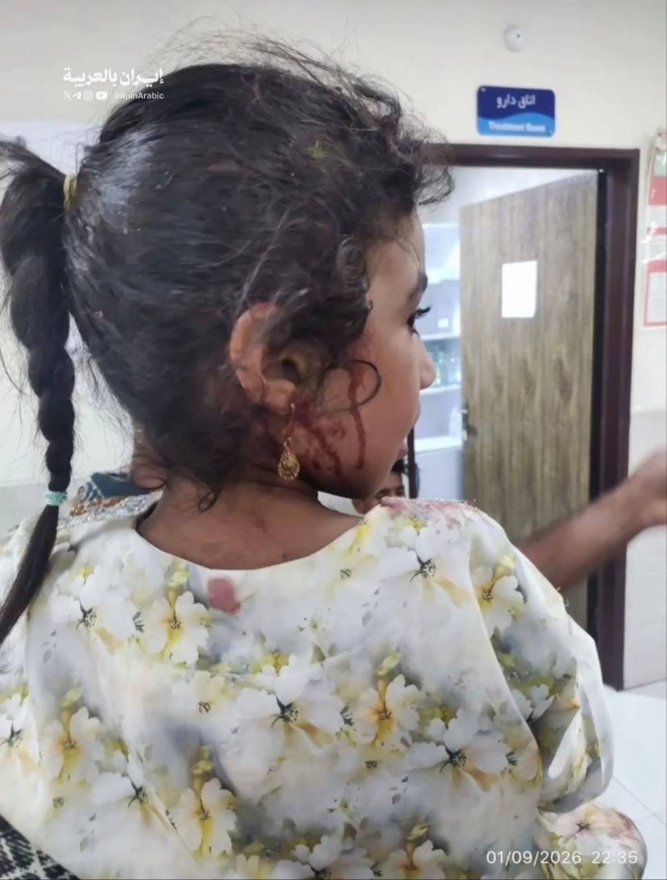 طفلة إيرانية مصابة في مستشفى إيراني 